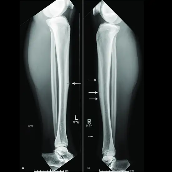 X-Ray Tibia AP and LAT View